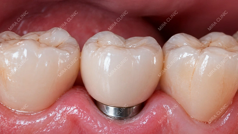 Soft-Tissue Seal Around a Dental Implant